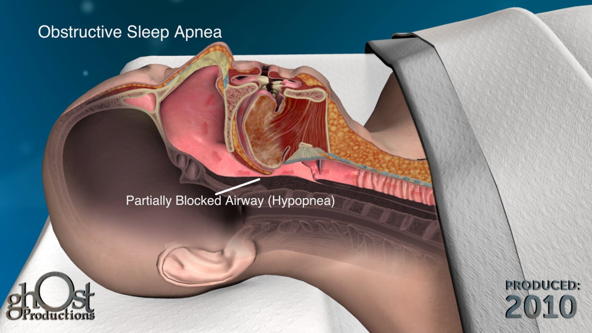 A Closer Look at Hypoglossal Nerve Stimulation for Obstructive Sleep Apnea  – Consult QD