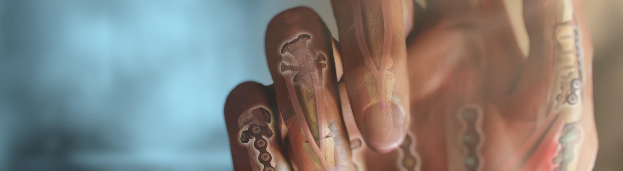 Contact Ghost Medical - Hand with medical device implants